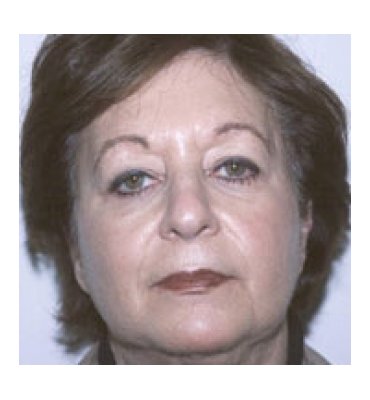 Facial Rejuvenation Treatments Before